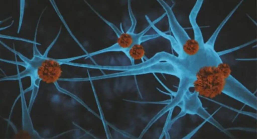 Droga Experimental Donanemab Retarda A Progressao Do Alzheimer Em 60 Para Pacientes Em Estagios Iniciais Da Doenca 1
