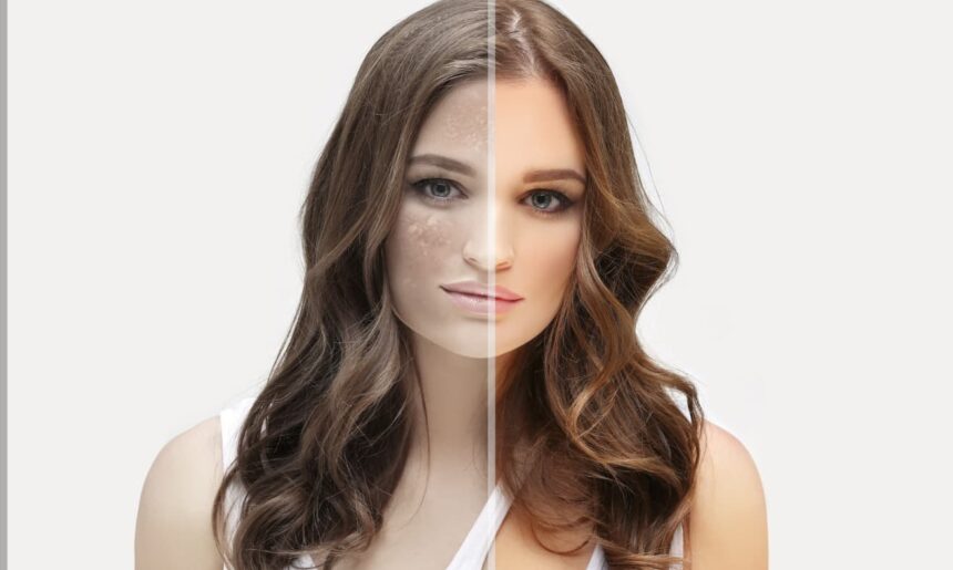 Comparação de tratamento dermatológico: rosto feminino dividido ao meio, mostrando pele afetada por manchas e pele saudável.